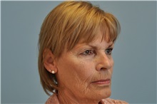 Facelift Before Photo by Paul Vanek, MD, FACS; Concord, OH - Case 32788