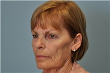Facelift Before Photo by Paul Vanek, MD, FACS; Concord, OH - Case 32788