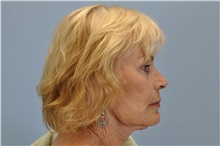 Facelift After Photo by Paul Vanek, MD, FACS; Concord, OH - Case 32788