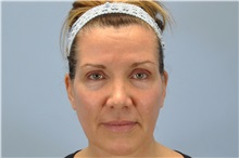 Botulinum Toxin Before Photo by Paul Vanek, MD, FACS; Concord, OH - Case 32791