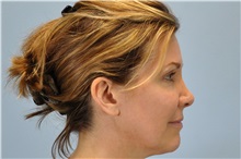Botulinum Toxin After Photo by Paul Vanek, MD, FACS; Concord, OH - Case 32791