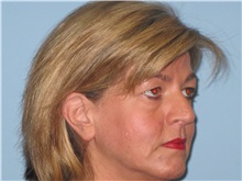 Skin rejuvenation and resurfacing After Photo by Paul Vanek, MD, FACS; Concord, OH - Case 32793