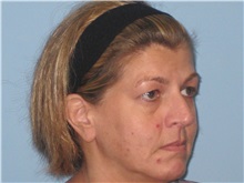 Skin rejuvenation and resurfacing Before Photo by Paul Vanek, MD, FACS; Concord, OH - Case 32793