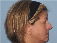 Skin rejuvenation and resurfacing Before Photo by Paul Vanek, MD, FACS; Concord, OH - Case 32793