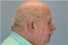 Skin rejuvenation and resurfacing After Photo by Paul Vanek, MD, FACS; Concord, OH - Case 32794