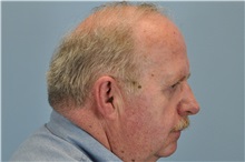 Skin rejuvenation and resurfacing Before Photo by Paul Vanek, MD, FACS; Concord, OH - Case 32794