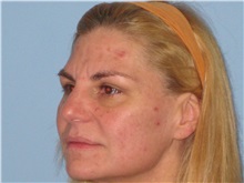Skin rejuvenation and resurfacing Before Photo by Paul Vanek, MD, FACS; Concord, OH - Case 32795