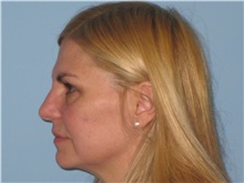 Skin rejuvenation and resurfacing After Photo by Paul Vanek, MD, FACS; Concord, OH - Case 32795