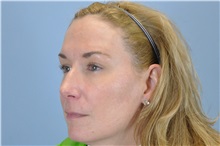 Skin rejuvenation and resurfacing After Photo by Paul Vanek, MD, FACS; Concord, OH - Case 32796