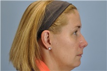 Skin rejuvenation and resurfacing Before Photo by Paul Vanek, MD, FACS; Concord, OH - Case 32796
