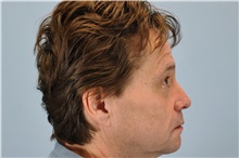 Dermal Fillers After Photo by Paul Vanek, MD, FACS; Concord, OH - Case 32798