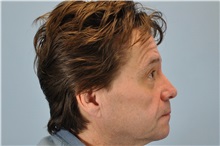 Dermal Fillers Before Photo by Paul Vanek, MD, FACS; Concord, OH - Case 32798