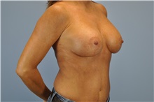 Breast Reconstruction After Photo by Paul Vanek, MD, FACS; Concord, OH - Case 32799