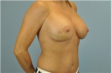 Breast Reconstruction Before Photo by Paul Vanek, MD, FACS; Concord, OH - Case 32799