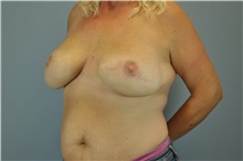 Breast Reconstruction After Photo by Paul Vanek, MD, FACS; Concord, OH - Case 32800