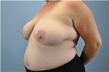 Breast Reconstruction Before Photo by Paul Vanek, MD, FACS; Concord, OH - Case 32800
