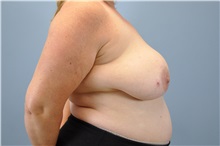 Breast Reconstruction Before Photo by Paul Vanek, MD, FACS; Concord, OH - Case 32800