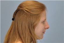 Rhinoplasty After Photo by Paul Vanek, MD, FACS; Concord, OH - Case 32856