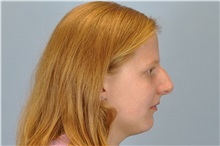 Rhinoplasty Before Photo by Paul Vanek, MD, FACS; Concord, OH - Case 32856
