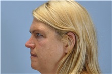 Brow Lift Before Photo by Paul Vanek, MD, FACS; Concord, OH - Case 32857