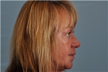 Eyelid Surgery After Photo by Paul Vanek, MD, FACS; Concord, OH - Case 32859