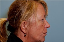 Eyelid Surgery Before Photo by Paul Vanek, MD, FACS; Concord, OH - Case 32859