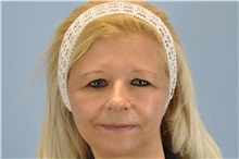 Brow Lift Before Photo by Paul Vanek, MD, FACS; Concord, OH - Case 32860