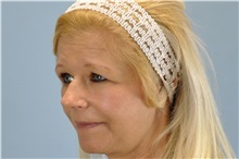 Brow Lift Before Photo by Paul Vanek, MD, FACS; Concord, OH - Case 32860