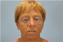 Eyelid Ptosis Repair After Photo by Paul Vanek, MD, FACS; Concord, OH - Case 33568