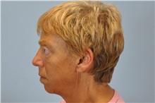 Eyelid Ptosis Repair After Photo by Paul Vanek, MD, FACS; Concord, OH - Case 33568