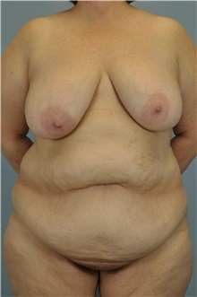 Body Lift Before Photo by Paul Vanek, MD, FACS; Concord, OH - Case 33569