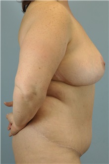 Body Lift After Photo by Paul Vanek, MD, FACS; Concord, OH - Case 33569