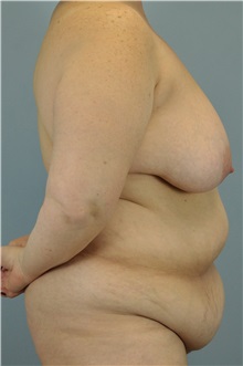Body Lift Before Photo by Paul Vanek, MD, FACS; Concord, OH - Case 33569