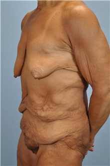 Body Lift Before Photo by Paul Vanek, MD, FACS; Concord, OH - Case 33570