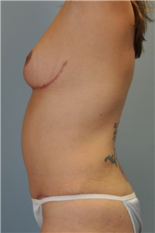 Liposuction After Photo by Paul Vanek, MD, FACS; Concord, OH - Case 33578