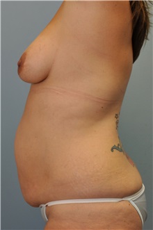Liposuction Before Photo by Paul Vanek, MD, FACS; Concord, OH - Case 33578