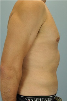 Liposuction After Photo by Paul Vanek, MD, FACS; Concord, OH - Case 33579