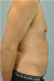Liposuction Before Photo by Paul Vanek, MD, FACS; Concord, OH - Case 33579