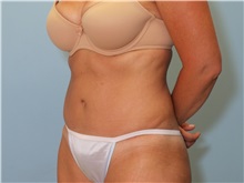 Tummy Tuck After Photo by Paul Vanek, MD, FACS; Concord, OH - Case 33581