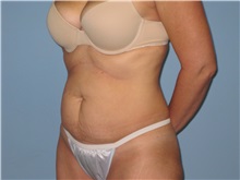 Tummy Tuck Before Photo by Paul Vanek, MD, FACS; Concord, OH - Case 33581
