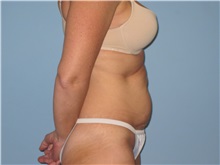 Tummy Tuck Before Photo by Paul Vanek, MD, FACS; Concord, OH - Case 33581