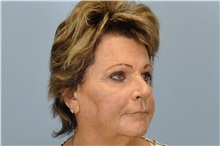Dermal Fillers After Photo by Paul Vanek, MD, FACS; Concord, OH - Case 34023