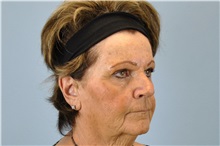 Dermal Fillers Before Photo by Paul Vanek, MD, FACS; Concord, OH - Case 34023