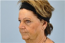 Dermal Fillers Before Photo by Paul Vanek, MD, FACS; Concord, OH - Case 34023