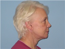 Facelift After Photo by Paul Vanek, MD, FACS; Concord, OH - Case 34025