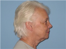 Facelift Before Photo by Paul Vanek, MD, FACS; Concord, OH - Case 34025