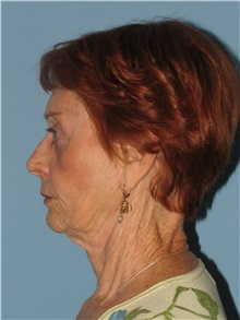 Facelift After Photo by Paul Vanek, MD, FACS; Concord, OH - Case 34026