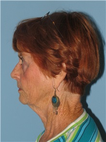 Facelift Before Photo by Paul Vanek, MD, FACS; Concord, OH - Case 34026