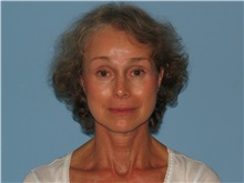 Facelift After Photo by Paul Vanek, MD, FACS; Concord, OH - Case 34028