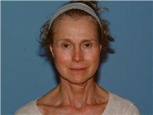 Facelift Before Photo by Paul Vanek, MD, FACS; Concord, OH - Case 34028